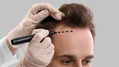 Hair Transplant in Dubai