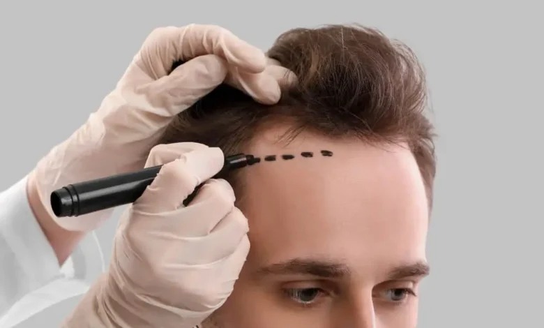 Hair Transplant in Dubai